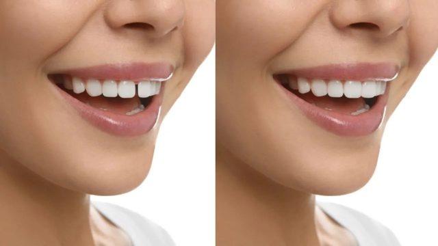 antes y despues diastema dental