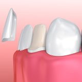 carillas dentales