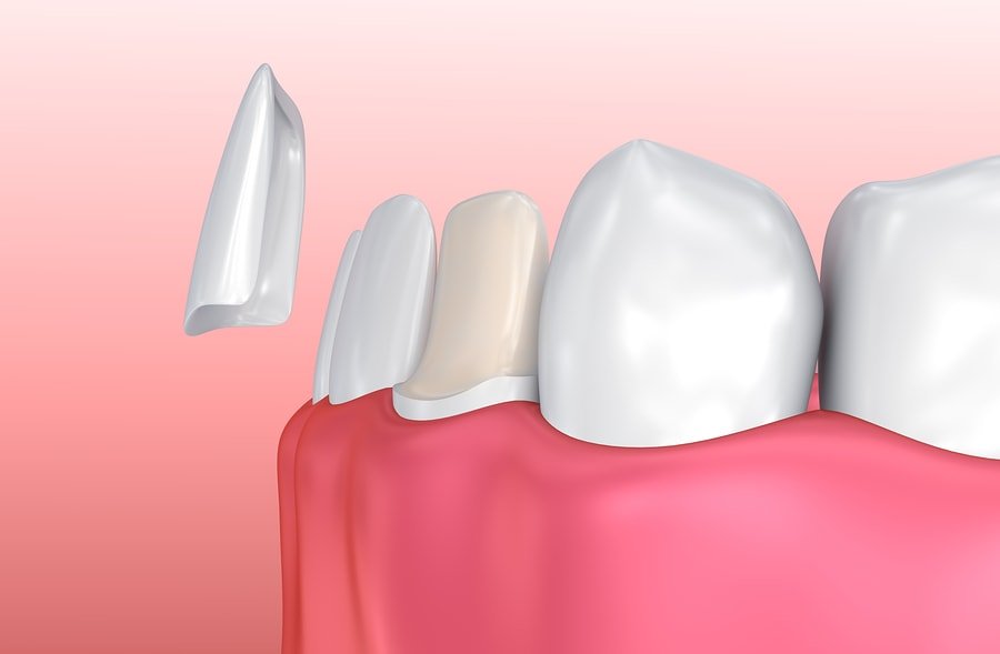 ¿Qué son las Carillas Dentales y para qué se Utilizan?