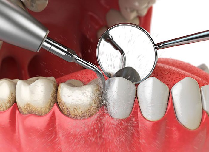 Curetaje Dental: Toda la información sobre el tratamiento