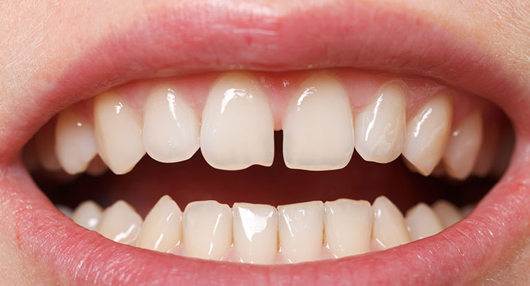 ¿Qué es un diastema dental y cuáles son sus causas?