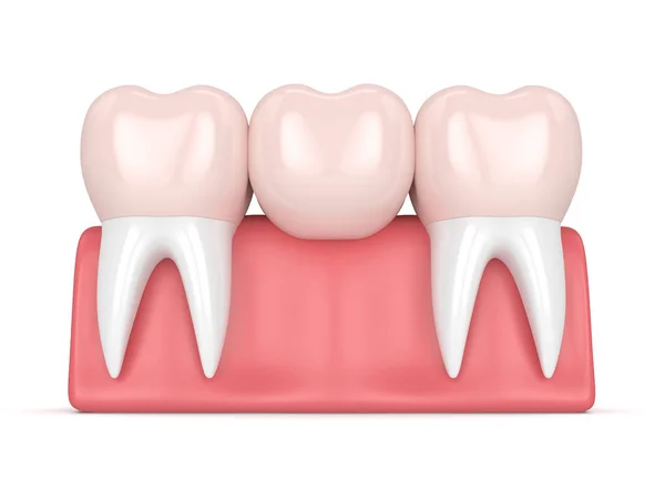 Puentes dentales: Información, recomendaciones y tipos existentes