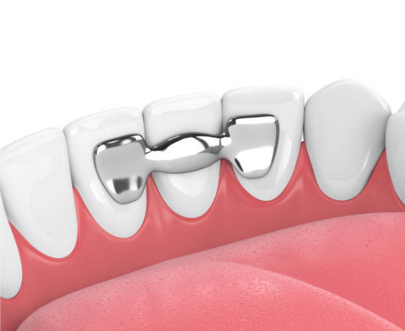 tipos de puentes dentales